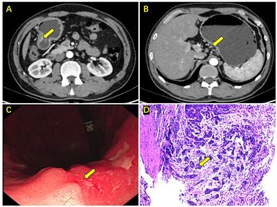 SOX combined with apatinib and camrelizumab in the treatment of resectable locally advanced gastric cancer: a case report